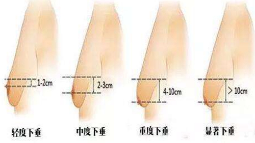 韩国纯真分析胸部下垂的类型