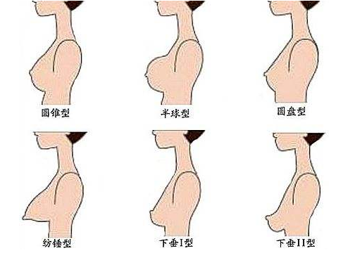 乳房形态及下垂等级区别示意图