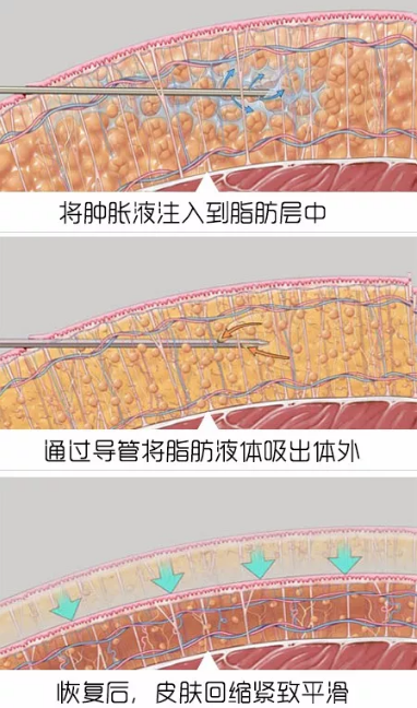 吸脂手术注意肿胀液原理图