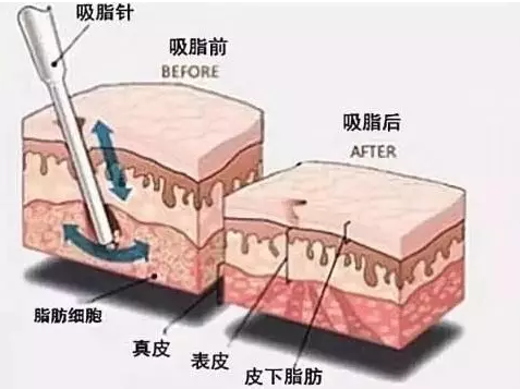 吸脂前后体积对比示意图