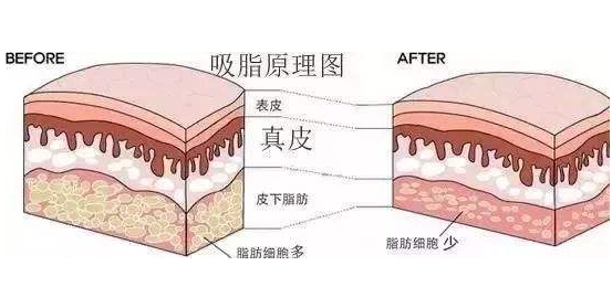 韩国安敬天腰腹吸脂手术效果