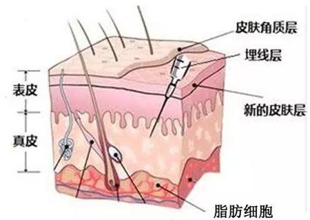 面部埋线提升层次分布