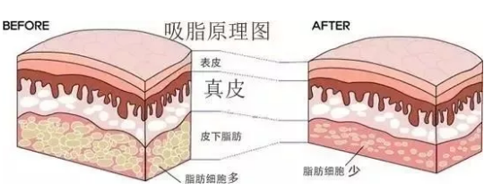 吸脂原理图-皮肤脂肪位置示意