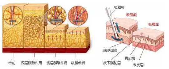 吸脂前后脂肪效果示意图