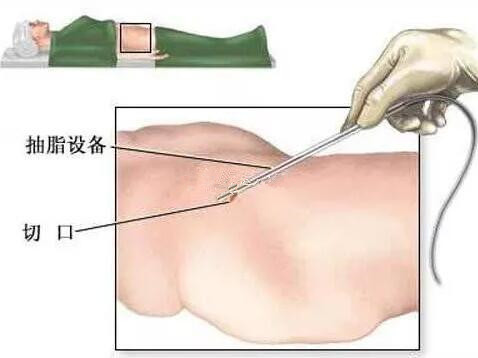 腰腹吸脂手术切口位置