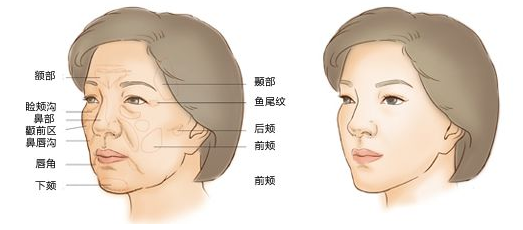 自体脂肪丰胸一次就能达到满意效果吗？