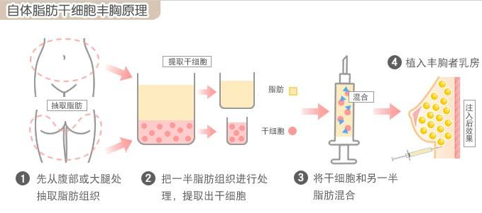 自体脂肪丰胸原理图