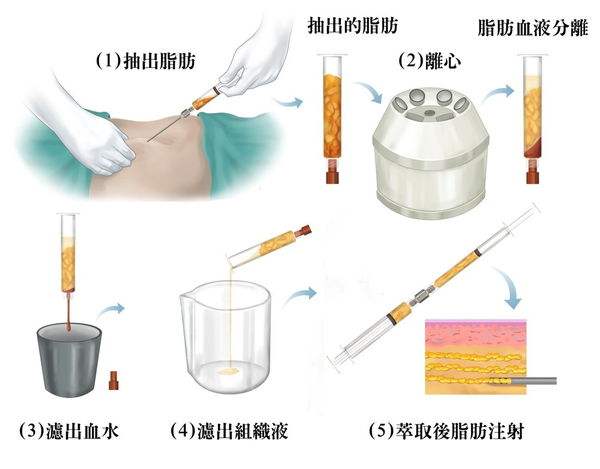 腰腹吸脂手术过程