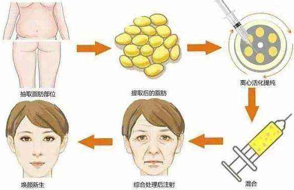 自体脂肪填充过程示意图