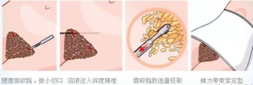 韩国腰腹吸脂手术原理