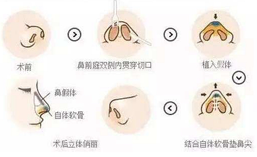 韩国鼻综合手术过程