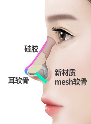韩国mesh假体隆鼻手术