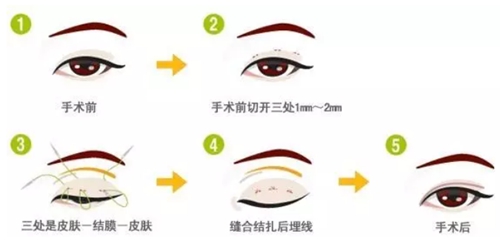 三点双眼皮手术方法