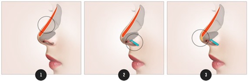 鼻部整形的手术方法