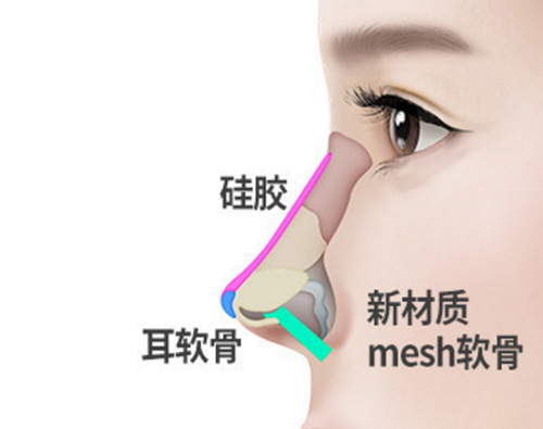韩国纯真整形外科mesh材料隆鼻