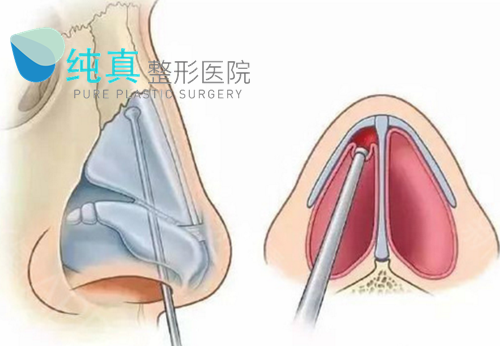 韩国纯真整形外科医院鼻中隔软骨隆鼻