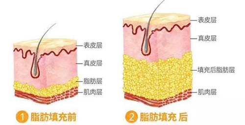 韩国纯真医院脂肪填充之后脂肪层的变化