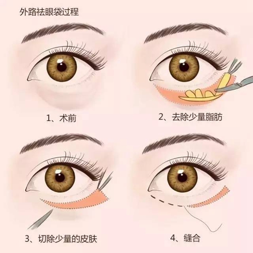韩国纯真整形外科外切法去眼袋手术示意图
