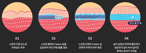 韩国纯真整形外科医院Cavern线内部线材结构