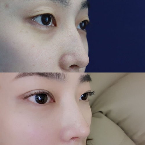 韩国纯真整形外科眼鼻综合手术案例