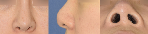 几种常见的挛缩鼻表现