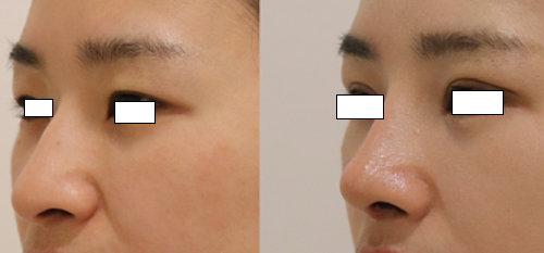 韩国眼鼻修复医生崔宰源院长鼻整形案例对比图