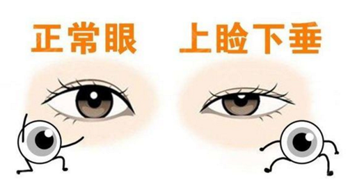 正常眼睛和上睑下垂眼睛的区别