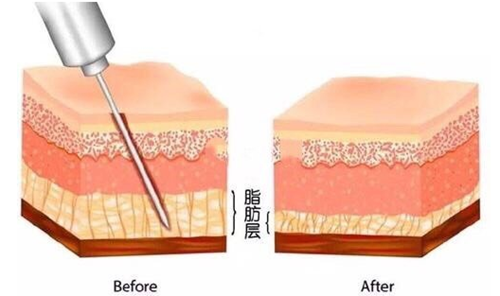 脂肪填充示意图