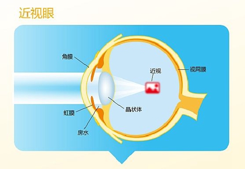 崔宰源院长表示，近视眼主要是眼球和视网膜的关系
