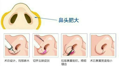 鼻翼缩小手术方法