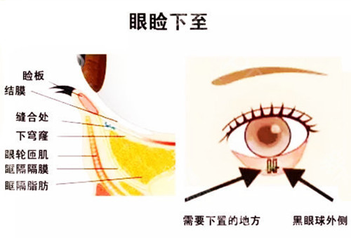 做眼睑向下手术的效果