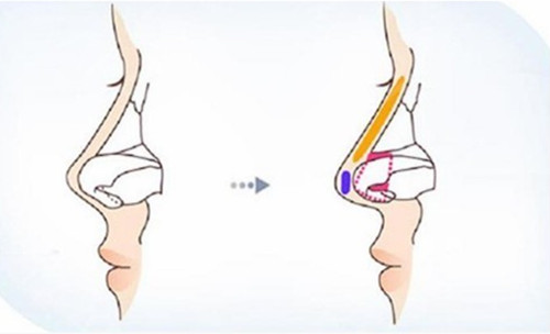 垫高鼻梁、延长鼻小柱手术方法