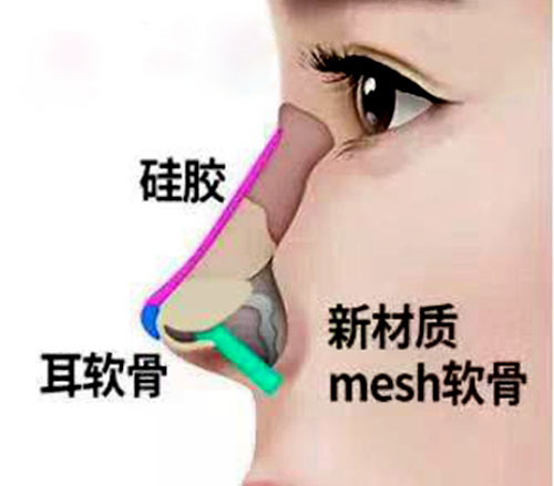 mesh隆鼻原理