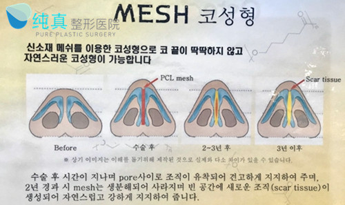 纯真医院mesh隆鼻手术方法