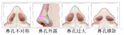 隆鼻后比较常见的几种问题鼻型