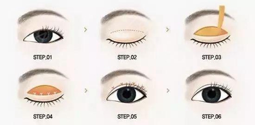 双眼皮手术的操作方法