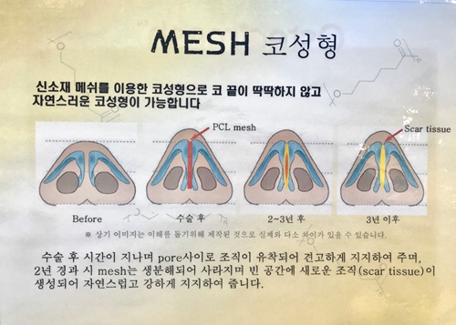 纯真医院mesh隆鼻操作方法