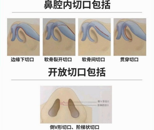 隆鼻手术不同的切口方式