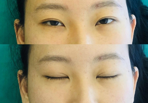 韩国纯真整形外科双眼皮修复手术前