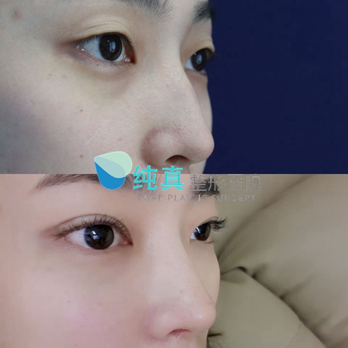 韩国纯真医院隆鼻术前术后对比