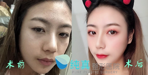 韩国纯真医院隆鼻案例