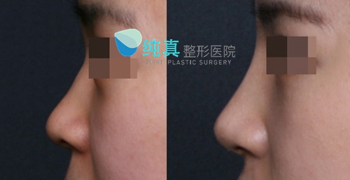 韩国纯真医院隆鼻术前术后对比